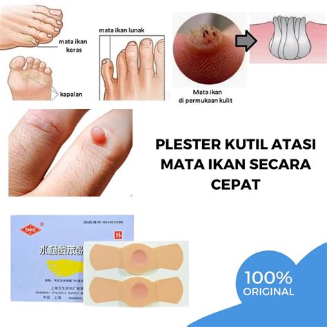 Jual Plester Mata Ikan Dan Kapalan Penghilang Kutil Di Leher Tangan