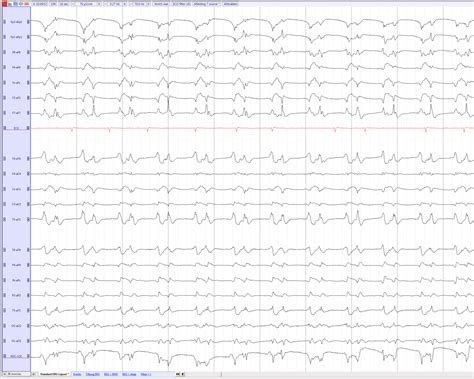 Gpd Generalized Periodic Discharges Eegpedia