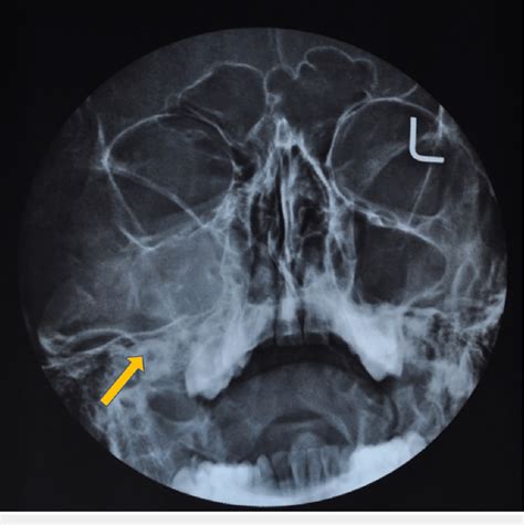 Plain Paranasal Sinus View Showing Mixed Radiopaque Radiolucent Lesion Download Scientific