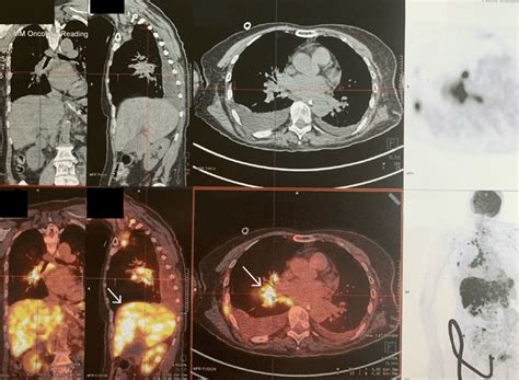 Positron Emission Tomography Scan Hypermetabolic Pulmonary Nodule Download Scientific Diagram