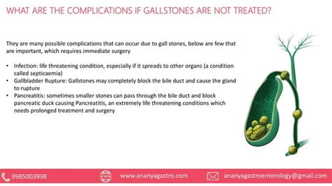 Gallbladder Stone Gallstones Causes Symptoms And Treatment By Ananya