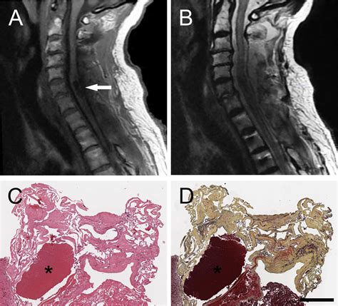 Intramedullary Cervical Spinal Cord Hemorrhagic Lesion With Evolving