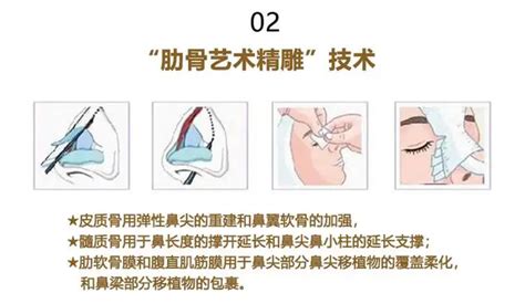 做肋骨鼻一年后鼻头和鼻梁有断层怎么办 知乎