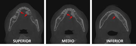 Torus mandibular Dento Metric Radiología Dental Oral y Maxilofacial