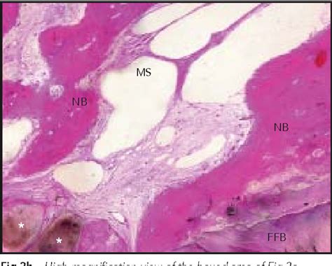 Figure 3 From Clinical And Histologic Evaluation Of Fresh Frozen Human