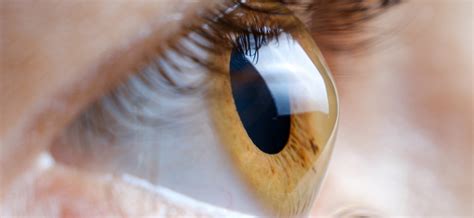 Keratoconus And Corneal Ectasia Viewpoint