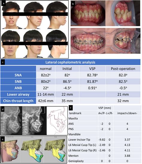 Clinical Photographs Virtual Surgical Planning Vsp Demonstrations