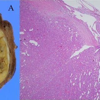 Minimally Invasive Encapsulated Angioinvasive Follicular Thyroid