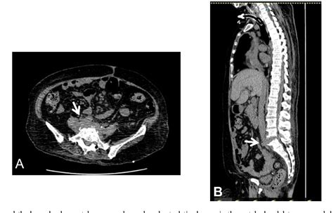 Figure 2 From A Case Of Emphysematous Pyelonephritis Caused By The Hypermucoviscosity Phenotype