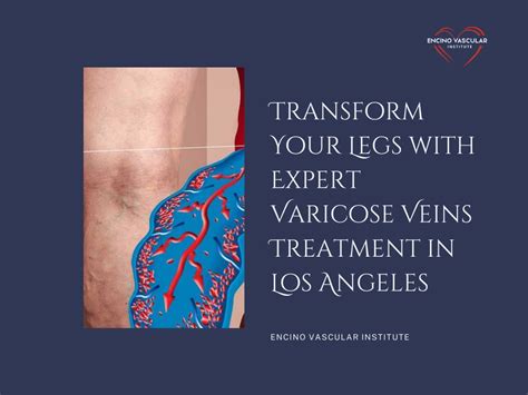 Ppt Transform Your Legs With Expert Varicose Veins Treatment In Los