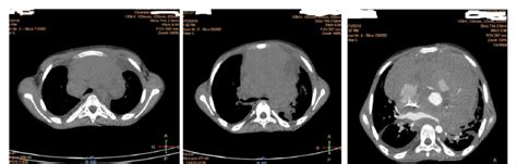 CT Scan Showing A Large Mediastinal Mass Involving The Aorta Superior