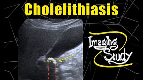 Cholelithiasis Ultrasound Case 74 Youtube