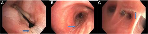 Persistent Expectoration Of Pulmonary Artery Embolization Coils