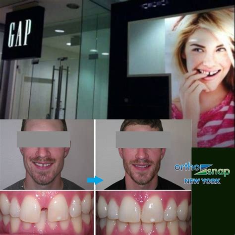 Fix This Gap Without Braces ‪‎orthosnapnewyork‬ Comfortable Invisible Affordable