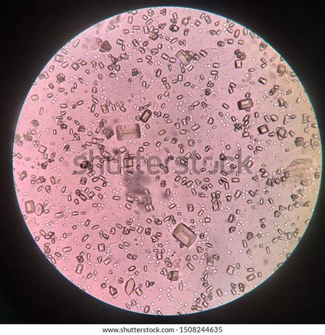 Urine Analysis Finding Microscope Show Crystal Stock Photo