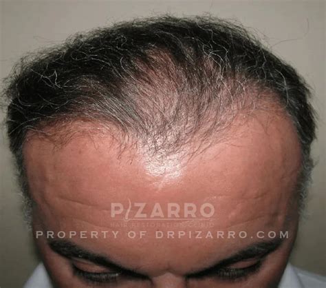 Gallery Pizarro Hair Restoration