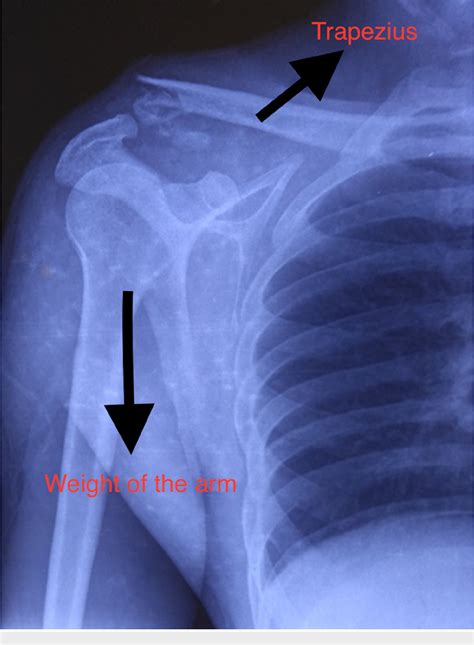 Figure 1 From Clinical Outcome Of Neer Type Ii Lateral End Clavicle Fractures With