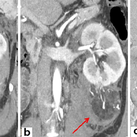 Selective Angiography Of The Left Renal Artery And Lower Renal Artery Download Scientific