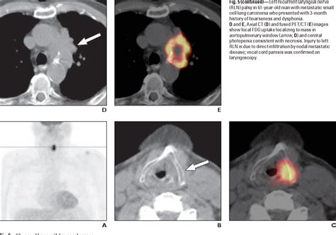 Figure From Spectrum Of F Fdg Pet Ct Findings In Oncology Related