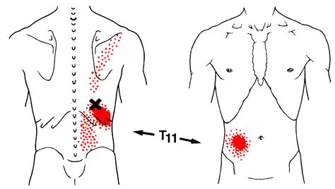 Pin On Trigger Points