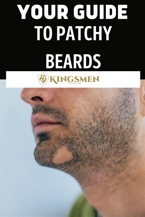 A Guide To Patchy Beards Patchy Beard Beard Treatment Patchy