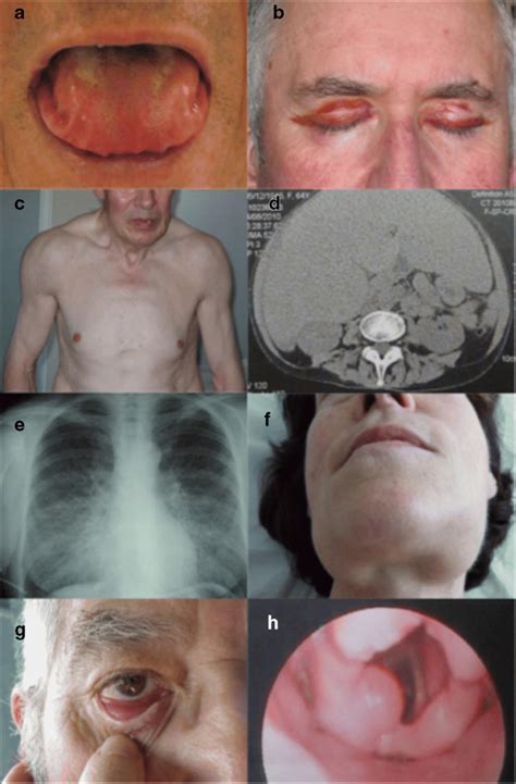 Amiloidosis Por Macroglosia