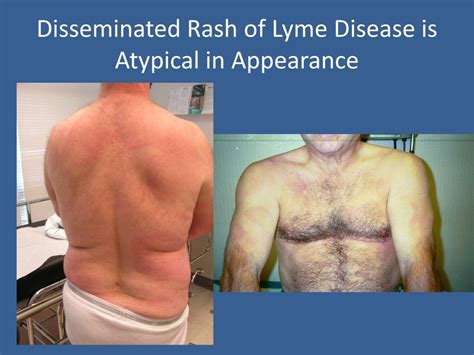 Ppt Lyme Disease And Post Treatment Lyme Disease Syndrome Powerpoint Presentation Id2362370