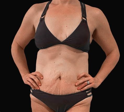 Tummy Tuck Before After Estetica Istanbul