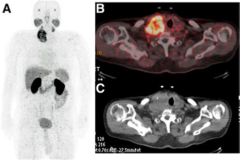 Follicular Thyroid Cancer Ultrasound