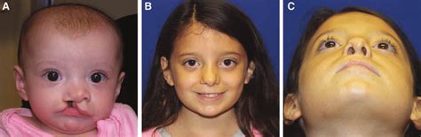 Right Unilateral Cleft Lip And Nasal Deformity A Preoperative Ap Download Scientific Diagram