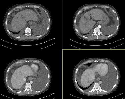 Hcc Liver Dynamic Ct 네이버 블로그