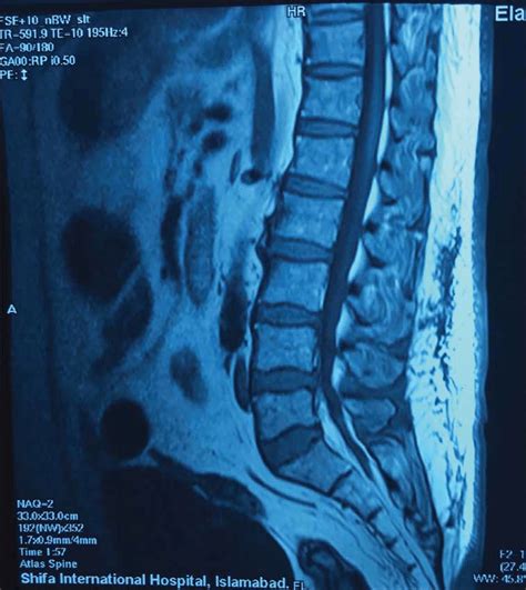 Abnormal Mri Lumbar Spine