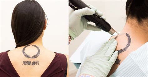 Things No One Tells You About Getting A Tattoo Removed