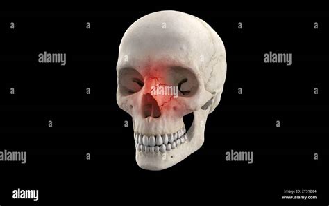 D Medical Illustration Of Cranial Nose Fracture On Human Skeleton