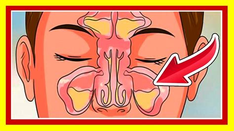 Como Destapar Una Nariz Tapada En Solo Minutos Volver S A Respirar