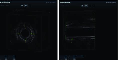Internal And External Anal Sphincter Thickness In Control Patient