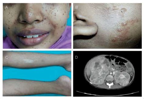 A Telangiectatic Papules Over The Cheeks Angiofibromas B