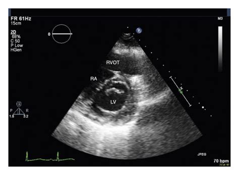 Parasternal short-axis view at the mitral valve level, performed on the ...