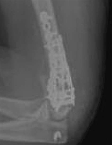 Heterotopic Ossification After The Use Of Commercially Available Recombinant Human Bone