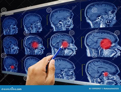 Imaging A Risonanza Magnetica E X28 MRI E X29 Del Cervello Del Tumore