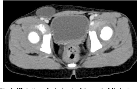 Figure 1 From Hydrocele Of The Canal Of Nuck Semantic Scholar