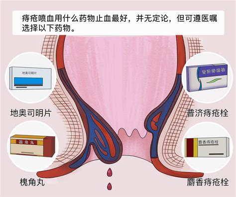 痔疮喷血用什么药止血最好 有来医生