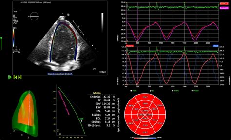 Apical Four Chamber View For Strain Analysis Download Scientific Diagram