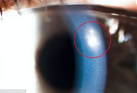 How Carelessness With Contact Lenses Could Leave You Blind Daily Mail