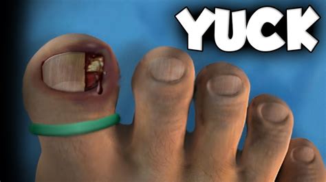 Ingrown Toenail Removal And Lasic Eye Surgery Youtube