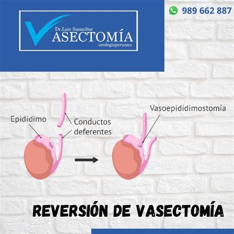 La Reversión De Vasectomía Tiene Altas Tasas De éxito Urología