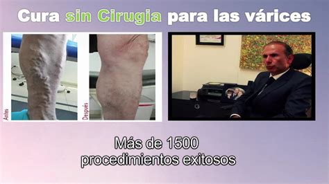 Cura Para Venas Varices SIN CIRUGIA En Bogota Colombia Tratamiento