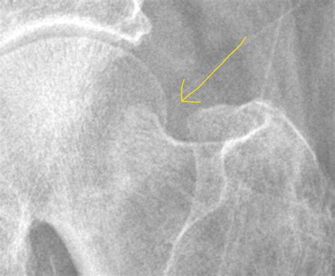 Femoral Neck Fracture Radiology Case Radshare Net