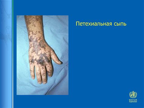 Лихорадка. Стадии ведения больного ребенка - презентация онлайн