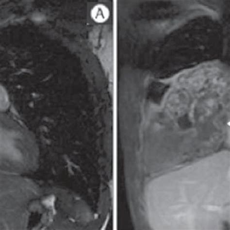 Male, 22-year-old patient with a malignant nonseminomatous germ cell ...